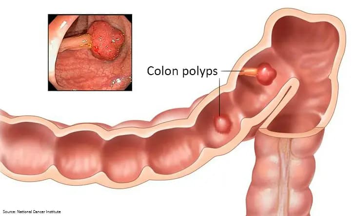 What Is Colon (Intestinal) Cancer? What Are Its Symptoms? What Causes It?