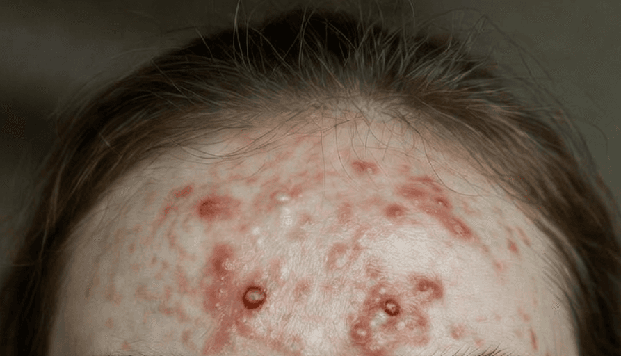 What is Acne? How is it Treated?