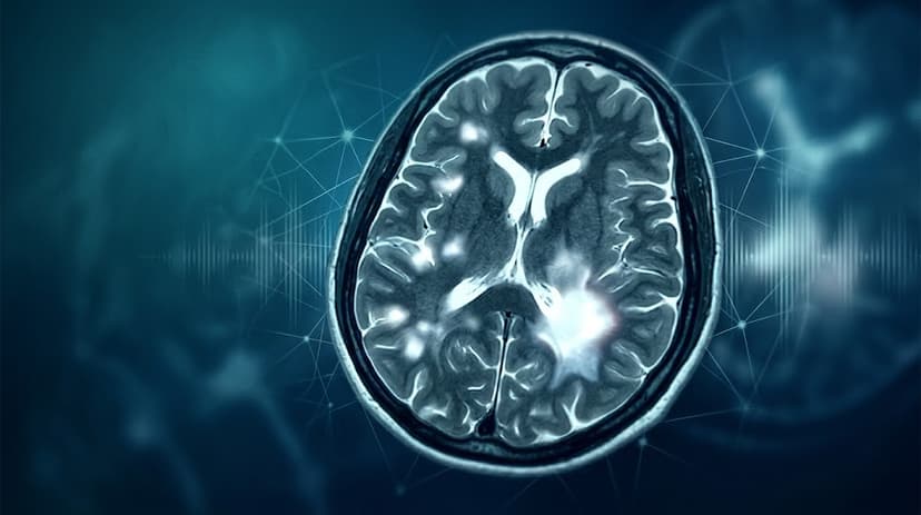 Hiperintens Lezyonlar Nedir? Oluşum Nedenleri, Belirtileri ve Tedavi Yaklaşımları