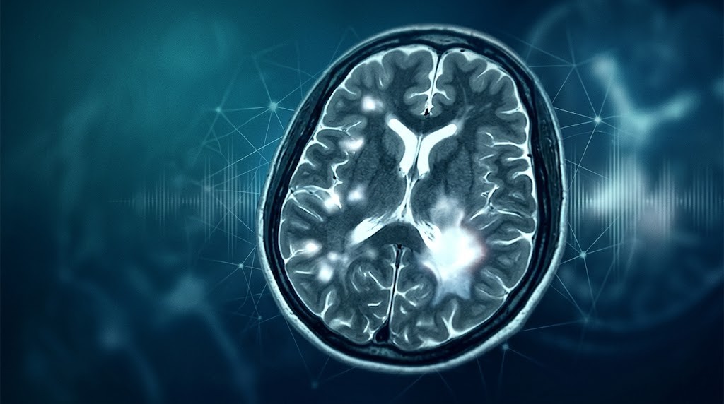 What Are Hyperintense Lesions? Causes of Formation, Symptoms, and Treatment Approaches